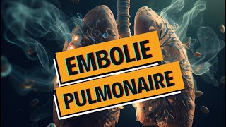 EMBOLIE PULMONAIRE et PHLEBITE  tout comprendre  WhyDoc 1 [upl. by Buke417]