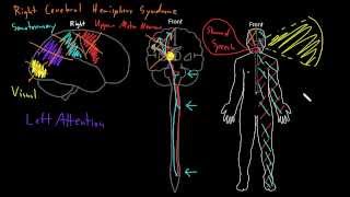 Syndrome Right cerebral hemisphere syndromes [upl. by Lounge]