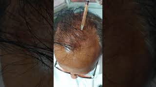 PRP to Hair Loss Hair Regrowth Treatment [upl. by Atiekram]