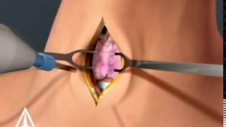 Tracheotomy  3D animation [upl. by Anniroc]