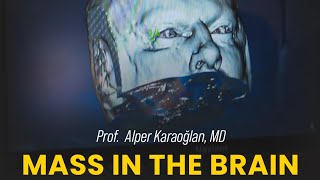 Mass In The Brain  Prof Alper Karaoğlan MD [upl. by Yelmene477]