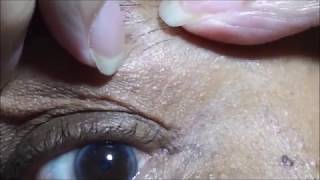 Skin Tag Removal with Apple Cider Vinegar 2017 [upl. by Marilyn]