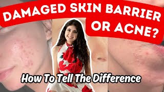 Acne VS Damaged Skin Barrier  4 Practical Differences amp Treatment Routine [upl. by Demona248]