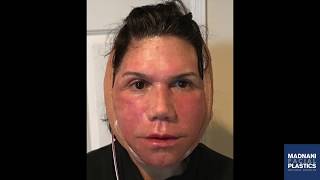 Facelift amp Neck lift Daily healing photos  2 week post op testimonial video [upl. by Reldnahc]