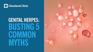 Busting 5 Myths About Genital Herpes [upl. by Melinde]