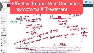 Effective Retinal vein occlusion Symptoms Treatment neurology 177  First Aid USMLE Step 1 [upl. by Gaudet]