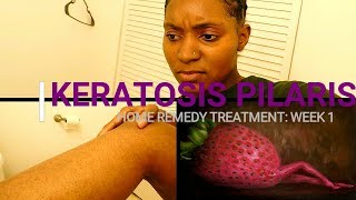 HOW TO REMOVE KERATOSIS PILARIS Week 1 Home Remedy Treatment [upl. by Leikeze166]