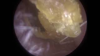 Ear Wax Removal and Dead Skin Removal using Endoscopic Microsuction  330 [upl. by Moya314]