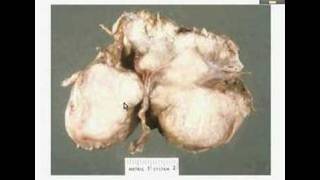 HistopathologyBrain Meningioma [upl. by Munsey]