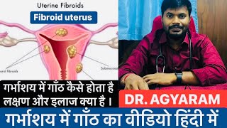 गर्भाशय में गॉंठ । Fibroid Uterus  Dr AGYARAM doctor hindi uterus fibroid video viralvideo [upl. by Ileray]