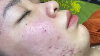 Acne treatment for Spa Linh Mun 2023 001 [upl. by Yael]