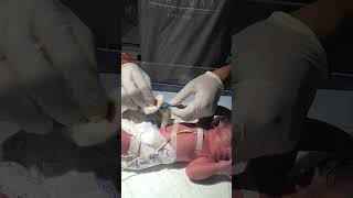 Cutting the navicular of a newborn baby sumitnicunursingstm youtubeshorts nursing newbornbaby [upl. by Arayc]