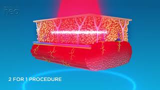 Emsculpt Neo VIDEO  Mechanism of Action [upl. by Asi498]