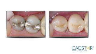 cadstarorg Blog CEREC 40 InlayOnlay Parameters [upl. by Aronaele470]