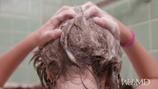 How to Remove Head Lice  WebMD [upl. by Sajet]