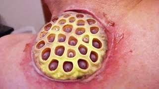 Lotus Pod Cyst Trypophobia Immersion Therapy Part Two [upl. by Mizuki]