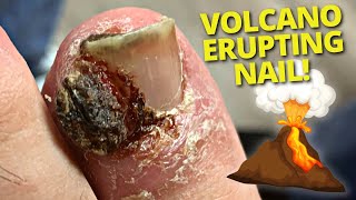 HUGE Granuloma Removal On Infected Ingrown Toenail [upl. by Bortman66]