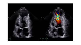 How to Assess the Level of Obstruction with Echocardiography in Patients with HCM [upl. by Srevart]