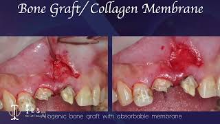 Restorative Crown Lengthening in Esthetic Zone amp Apicoectomy with Giuded Tissue Regeneration V [upl. by Hitt795]