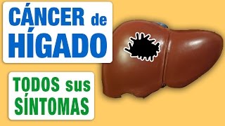 Todos los Síntomas del Cáncer de Hígado [upl. by Urana]