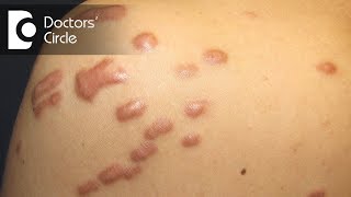 What is the best treatment for Keloid in young people  Dr Pavan Murdeshwar [upl. by Leodora]