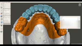 Full Arch Implant Provisional FP1 — Meshmixer [upl. by Nedrah]