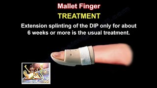 Mallet Finger Treatment  Everything You Need To Know  Dr Nabil Ebraheim [upl. by Ettessil]