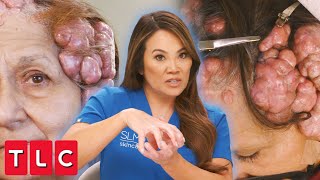 Dr Lee Removes Gigantic CauliflowerLike Bumps on Patients Head  Dr Pimple Popper [upl. by Bak]