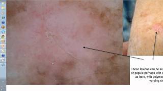 Dermoscopy Made Simple  Amelanotic melanoma [upl. by Hsizan]