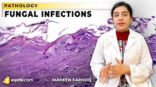 Fungal Infections  Candida  Pathology Video Lectures  VLearning  sqadiacom [upl. by Enotna24]