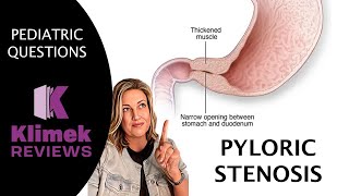 PYLORIC STENOSIS  questions with Dr Sharon [upl. by Roe18]