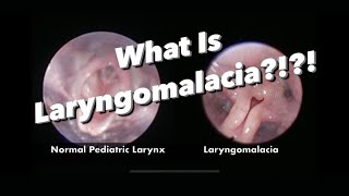 Laryngomalacia  What is it what are the symptoms how is it managed [upl. by Stacia]