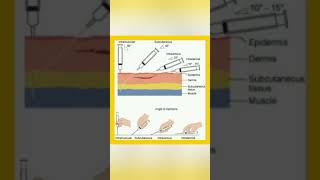 Route  technique of injection administration 💉knowledge easylearning shortsvideo shayari [upl. by Laleb]