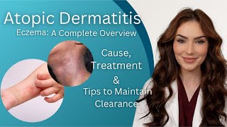 Atopic Dermatitis  Diagnosis Treatment and Maintenance Tips [upl. by Garber]