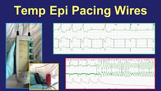 Surgical epicardial pacing wires  uses and management [upl. by Ennaisoj521]