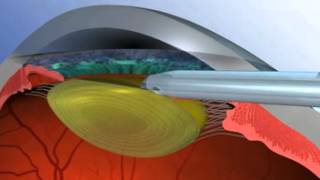 Restor Cataract Surgery [upl. by Farleigh]