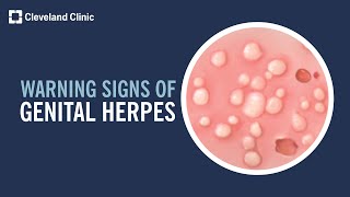 5 Warning Signs of Genital Herpes [upl. by Nennek]