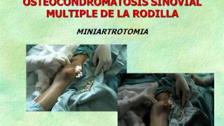 Dr David González Aceves OSTEOCONDROMATOSIS DE RODILLA wmv [upl. by Tattan]