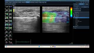 IQ 308 TFAST LUNG ULTRASOUND ELASTOGRAPHY PULMONARY EFFUSION HWD COUGH HARD  FELINE [upl. by Avirt]