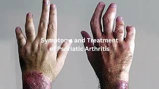 Symptoms and Treatment of Psoriatic Arthritis [upl. by Meagan685]