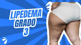 LIPEDEMA grado 3 postoperatorio [upl. by Lumpkin]