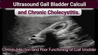 Ultrasound Gall bladder Chronic Cholecystitis and Calculi [upl. by Ushijima279]