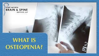 Fort Worth Brain and Spine Institute  What is Osteopenia [upl. by Tebzil]