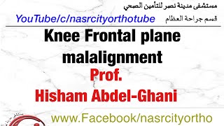 Knee frontal malalignmentProfHisham Abdelghani Nasrcity online lectures 2020 [upl. by Jeralee]