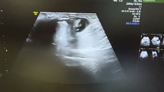 Ultrasound of strangulated umbilical hernia showing omental herniation with fluid [upl. by Eltsyek465]