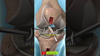 What are the advantages of an arthroscopic surgery  shprts [upl. by Ayouqat10]