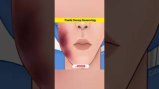 3D Animation Of Removing Teeth Decay factstalk [upl. by Cchaddie]