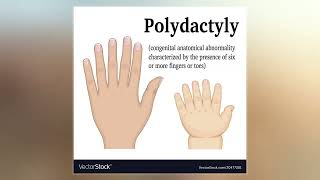 Polydactyly [upl. by Komsa825]