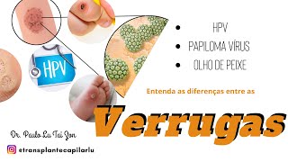 COMO TIREI CUIDEI DO OLHO DE PEIXE EM CASA  VERRUGA PLANTAR [upl. by Ahsatniuq]