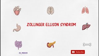 Zollinger Ellison Syndrome  Pathophysiology Clinical Menifestation Diagnosis and Treatment  ZES [upl. by Pate297]